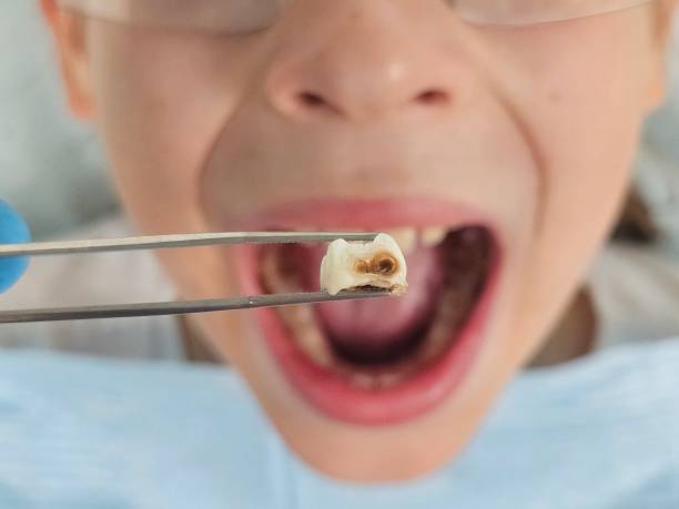 Best Emergency Tooth Extraction in Grant, MI
